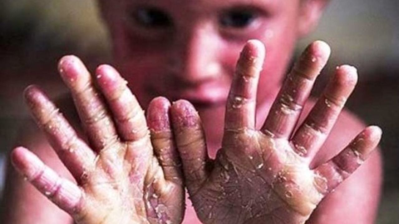 33 بیمار پروانه‌ای در همدان از بهزیستی خدمات دریافت می‌کنند