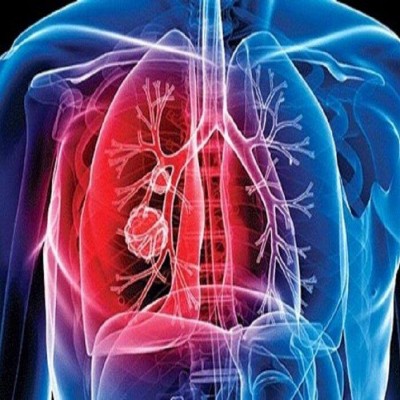 درمان و داروی بیماران مبتلایان به سل در همدان رایگان است