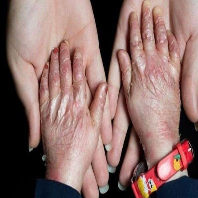 95 درصد بیماران «ای بی» حاصل ازدواج فامیلی